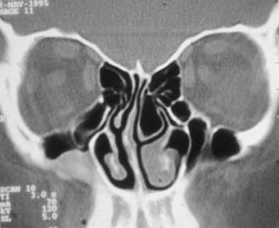 SINUSITIS - Suman Clinic